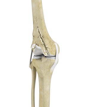 Complex Fractures