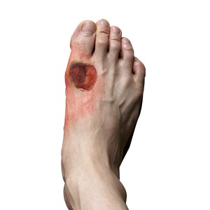 Diabetic Wound Management