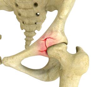 Fracture Care