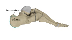 Haglund's Deformity