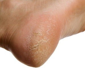 Heel Cracks