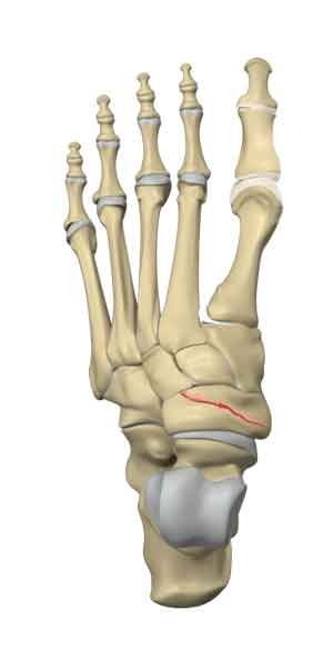 Navicular Stress Fracture