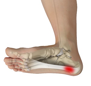 Shockwave Treatment for Plantar Fasciitis