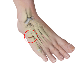 Stress Fractures of Foot and Ankle