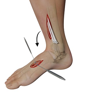 Tendon Transfer Foot Surgery