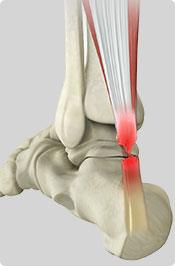 Achilles Tendonitis Pic