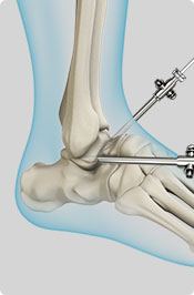 Ankle Arthroscopy Pic