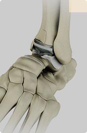 Ankle Replacement Pic
