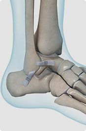 Ankle Sprains & Ligament Injuries Pic