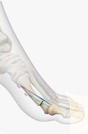 Bunion Surgery Pic