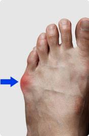Tailor’s Bunionette & Bunion Treatments Pic