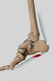 Heel Pain Pic