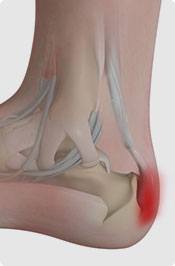 Insertional Achilles Tendinopathy Pic
