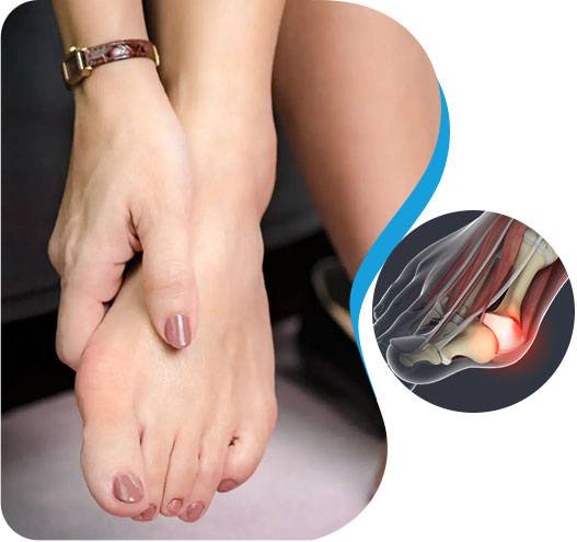 Minimally Invasive Bunion Surgery