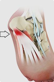 Plantar Fasciitis Pic