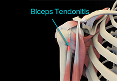 Biceps Tendon Rupture