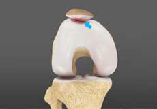 Chondromalacia Patella