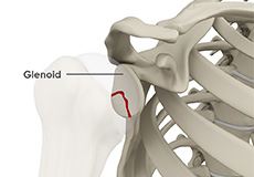Glenoid Fractures