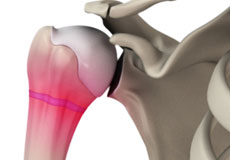 Shoulder Dislocation