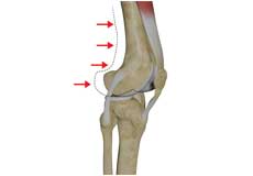 Posterolateral Instability