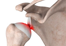 Open Shoulder Stabilization