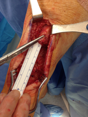 Achilles Disruption img1