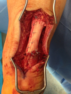 Achilles Disruption img2