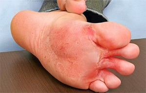 Tinea Pedis