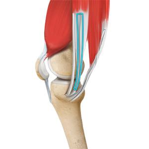 ACL Reconstruction Using Hamstring Tendon
