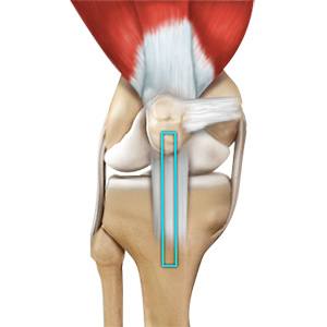 ACL Reconstruction Using Patellar Tendon