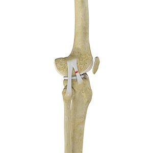 Anterolateral Ligament (ALL) Reconstruction