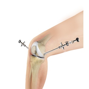 Arthroscopy of the Knee Joint
