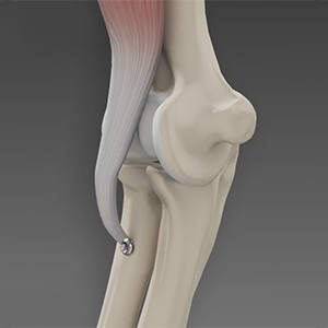 Biceps Tendon Repair