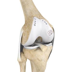 Cartilage Restoration