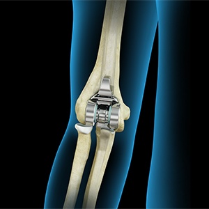 Elbow Joint Replacement
