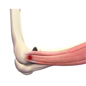 Elbow Sports Injuries