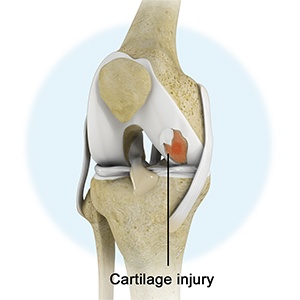 Knee Cartilage Defect/Injury