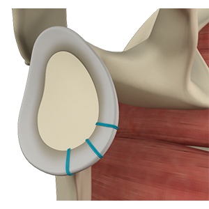 Labrum Tear