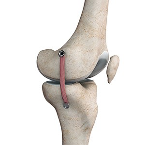 Medial Collateral Ligament (MCL) Repair & Reconstruction