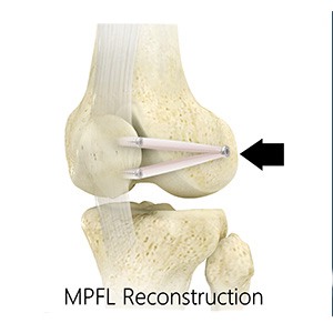 Medial Patellofemoral Ligament (MPFL) Reconstruction