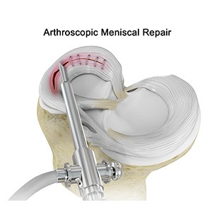 Meniscal Repair