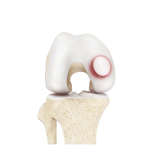 Osteochondral Allograft