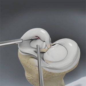 Partial Meniscectomy