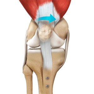 Patella Stabilization