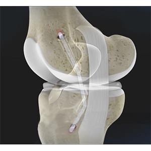 Posterior Cruciate Ligament (PCL) Reconstruction