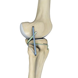 Posterolateral Corner (PLC) Reconstruction
