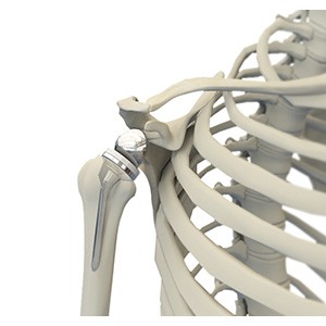 Reverse Total Shoulder Replacement