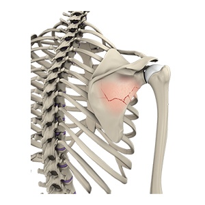 Shoulder Sports Injuries
