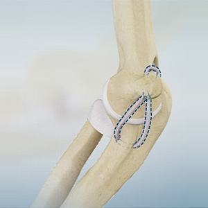 Tommy John Surgery