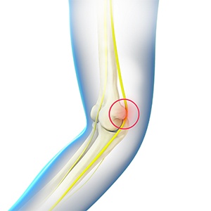 Ulnar Nerve Decompression